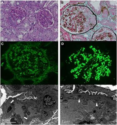 Case report: A pediatric case of MPO-ANCA-associated granulomatosis with polyangiitis superimposed on post-streptococcal acute glomerulonephritis